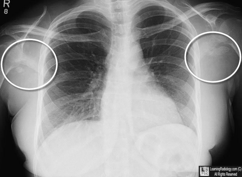 Heterotopic ossification